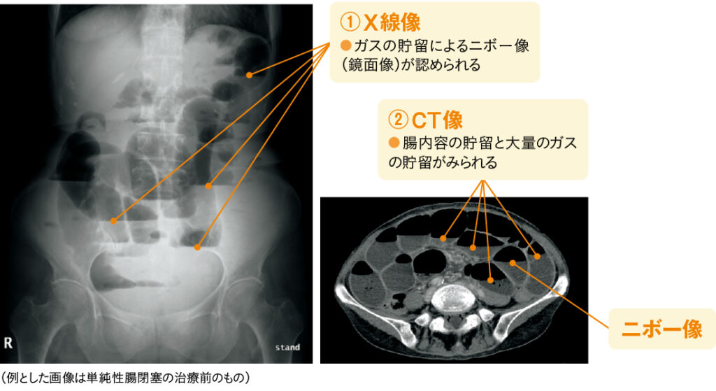 腸閉塞の画像の確認ポイントの図