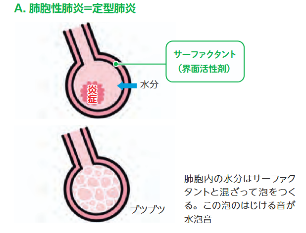 肺胞性肺炎における水泡音発生の機序