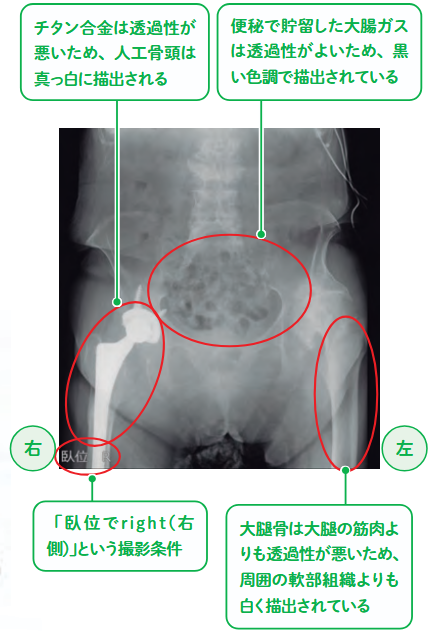 腹部単純X線画像の例の図