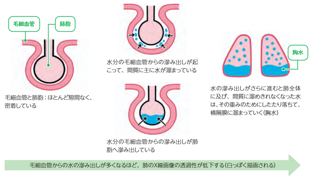 肺のX線透過性と水の滲み出しのモデル
