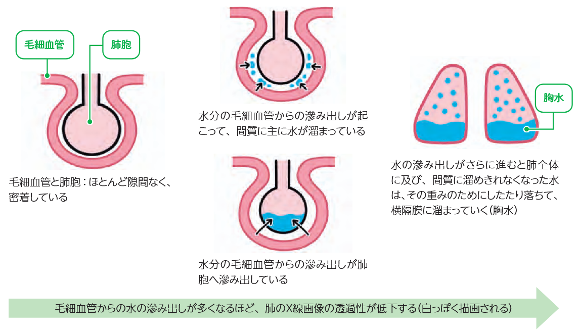 肺のX線透過性と水の滲み出しのモデル