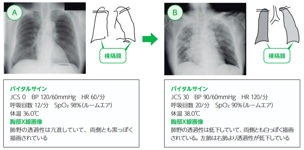 薬剤性の間質性肺炎に罹患した前後のバイタルサインと胸部X線画像