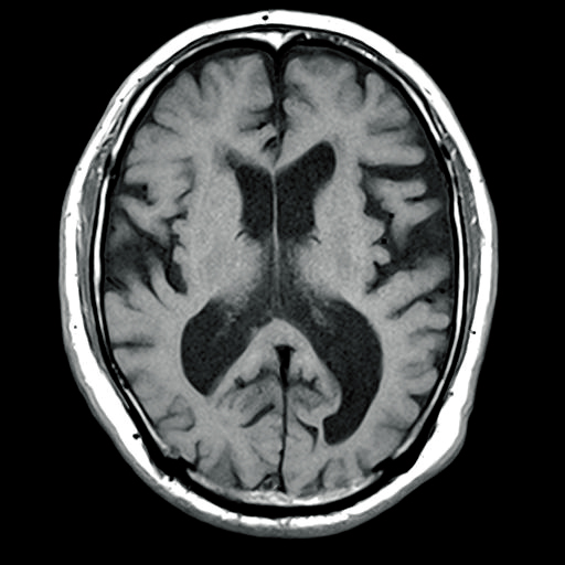 正常圧水頭症の頭部CT
