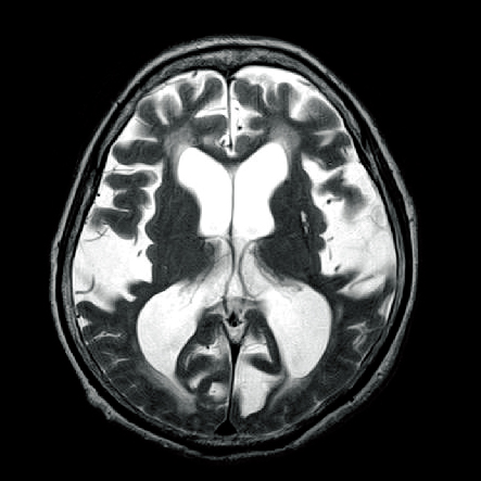 正常圧水頭症の頭部MRI（T1強調像）