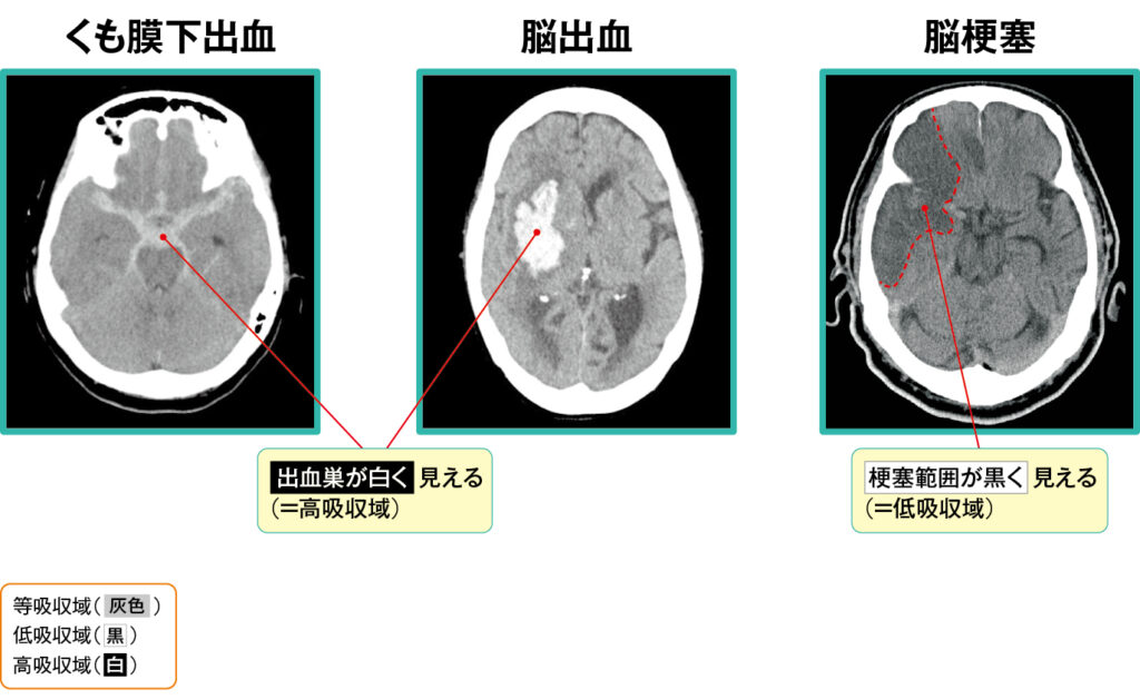 くも膜下出血、脳出血、脳梗塞のCT画像
