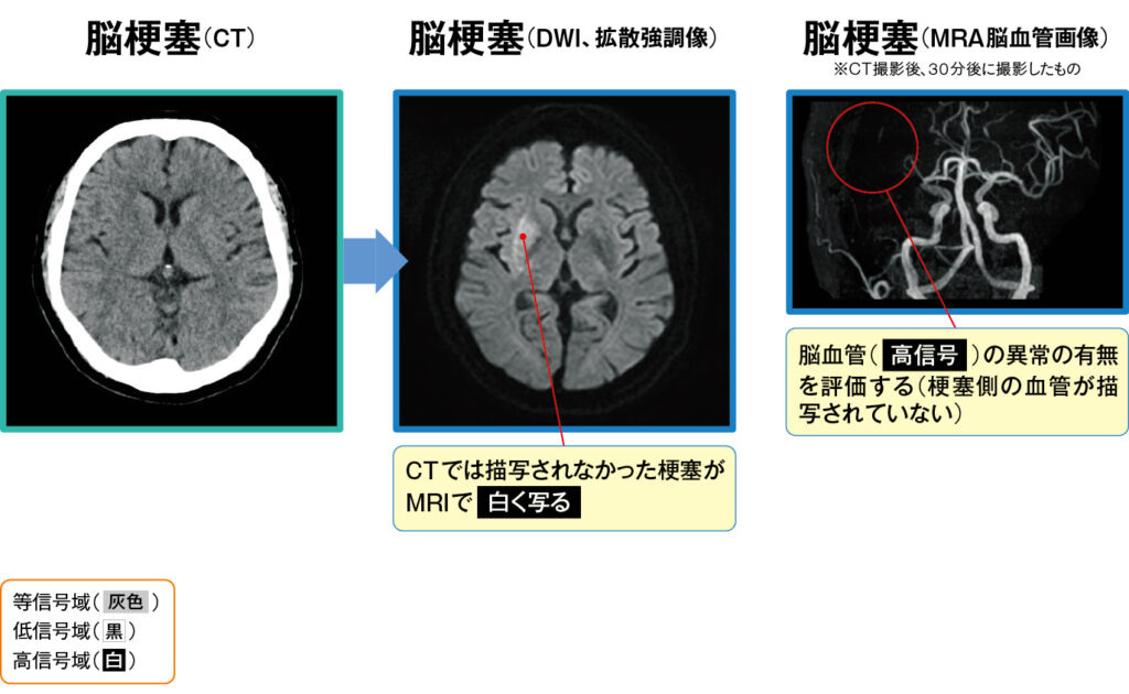 脳梗塞のCT画像、DWI画像、MRA画像
