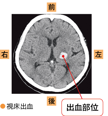 出血部位が認められる画像