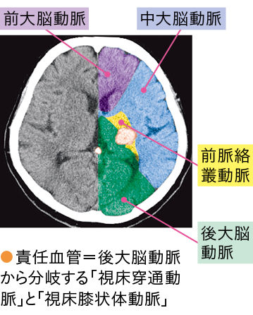 画像で血管の支配領域から責任血管を見る