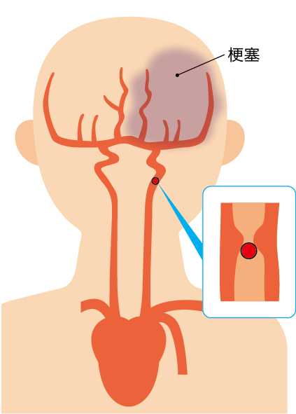 アテローム血栓性脳梗塞の図