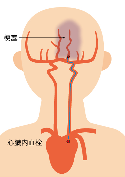 心原性脳梗塞の図
