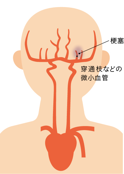 ラクナ梗塞の図