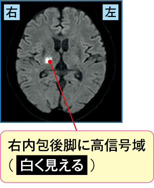 急性期アテローム血栓性脳梗塞のMRI