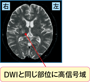 急性期アテローム血栓性脳梗塞のMRI(T2強調像)