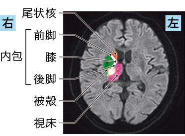 急性期アテローム血栓性脳梗塞の障害される部位