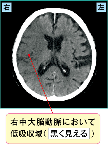 急性期の心原性脳梗塞のCT画像