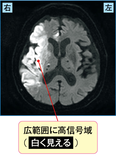 急性期の心原性脳梗塞のMRI(DDWI、拡散強調像)