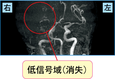 急性期の心原性脳梗塞のMRA画像