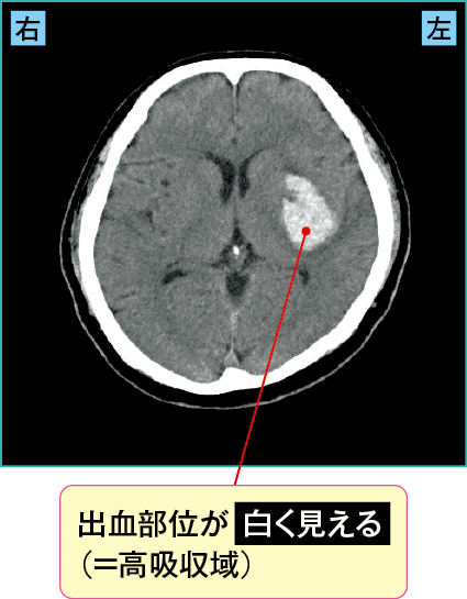 被殻出血のCT画像