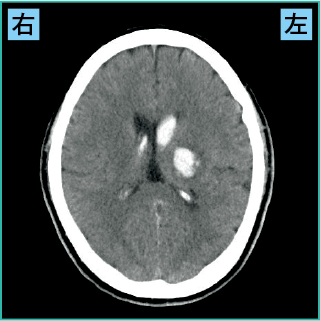 視床出血のCT画像