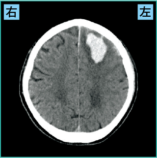 皮質下出血のCT画像