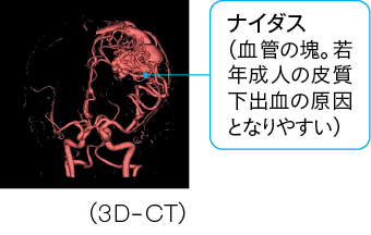 脳動静脈奇形(AVM)のCT画像