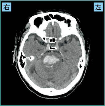 脳幹出血のCT画像