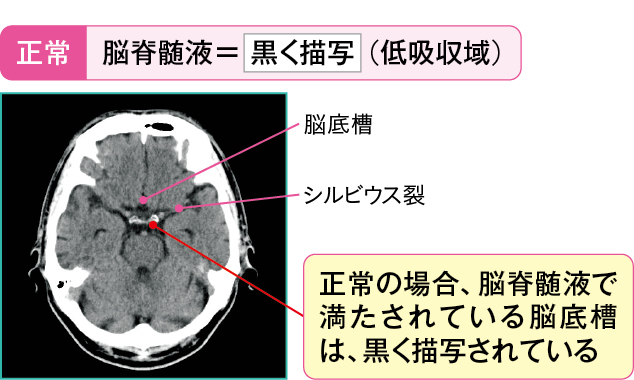 くも膜下の正常CT画像(中脳レベルのスライス画像)