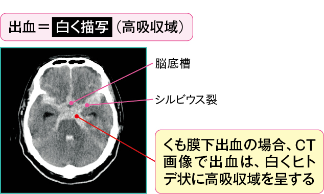 くも膜下出血のCT画像(中脳レベルのスライス画像)