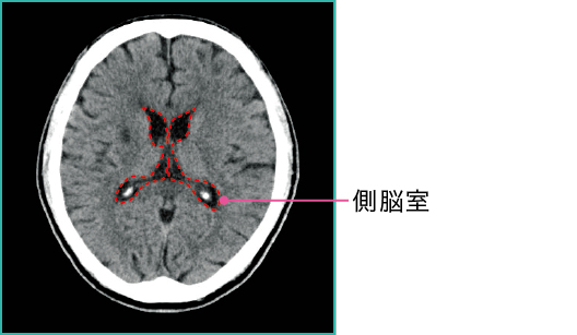 正常な頭部のCT画像