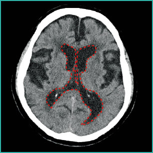 正常圧ス一等賞の頭部CT