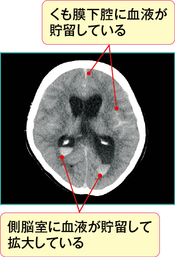 くも膜下出血発生直後の頭部CT