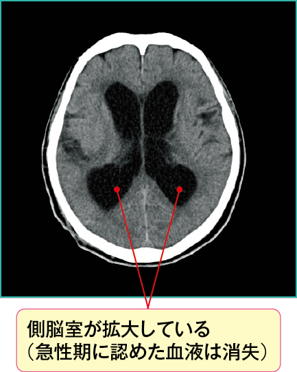 くも膜下出血発症1年後の頭部CT