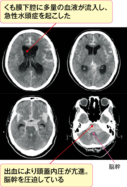 くも膜下出血による急性水頭症と脳ヘルニアの画像