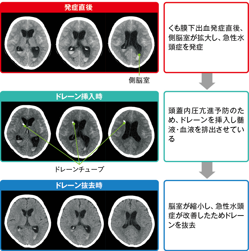 脳室ドレーン挿入による脳室の変化
