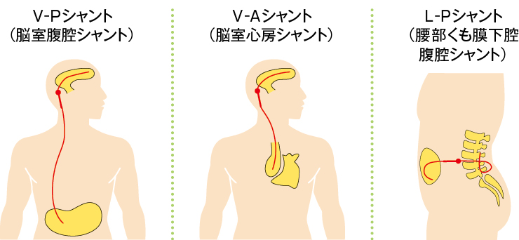 髄液シャント術のイメージ図