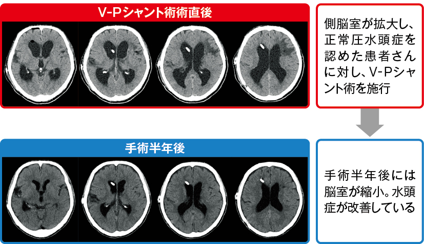 V-Pシャント挿入による脳室の変化