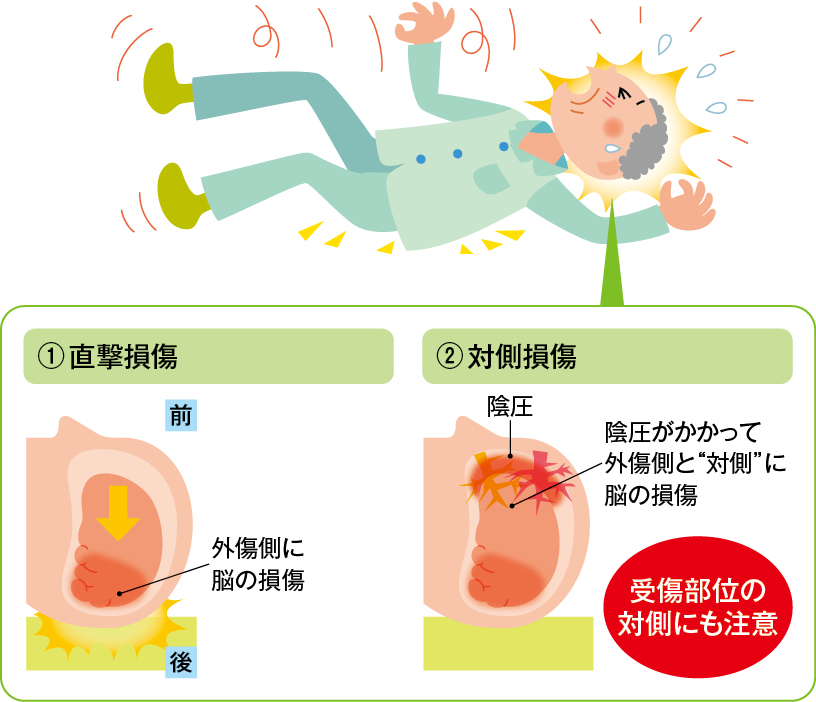 直撃損傷と対側損傷の表