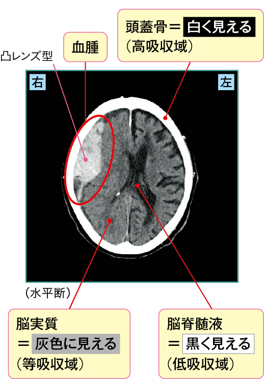 急性硬膜外血腫のCT画像