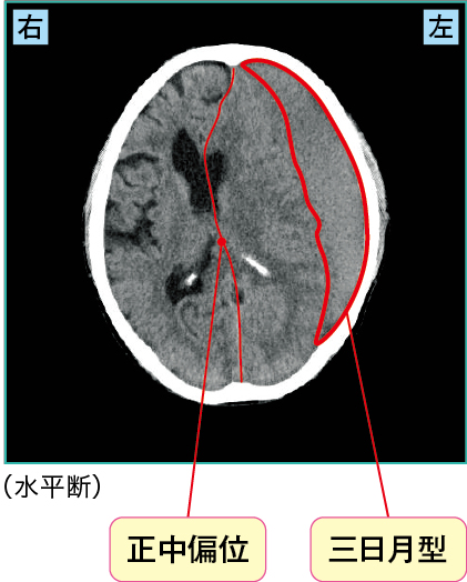 慢性硬膜下血腫のCT画像