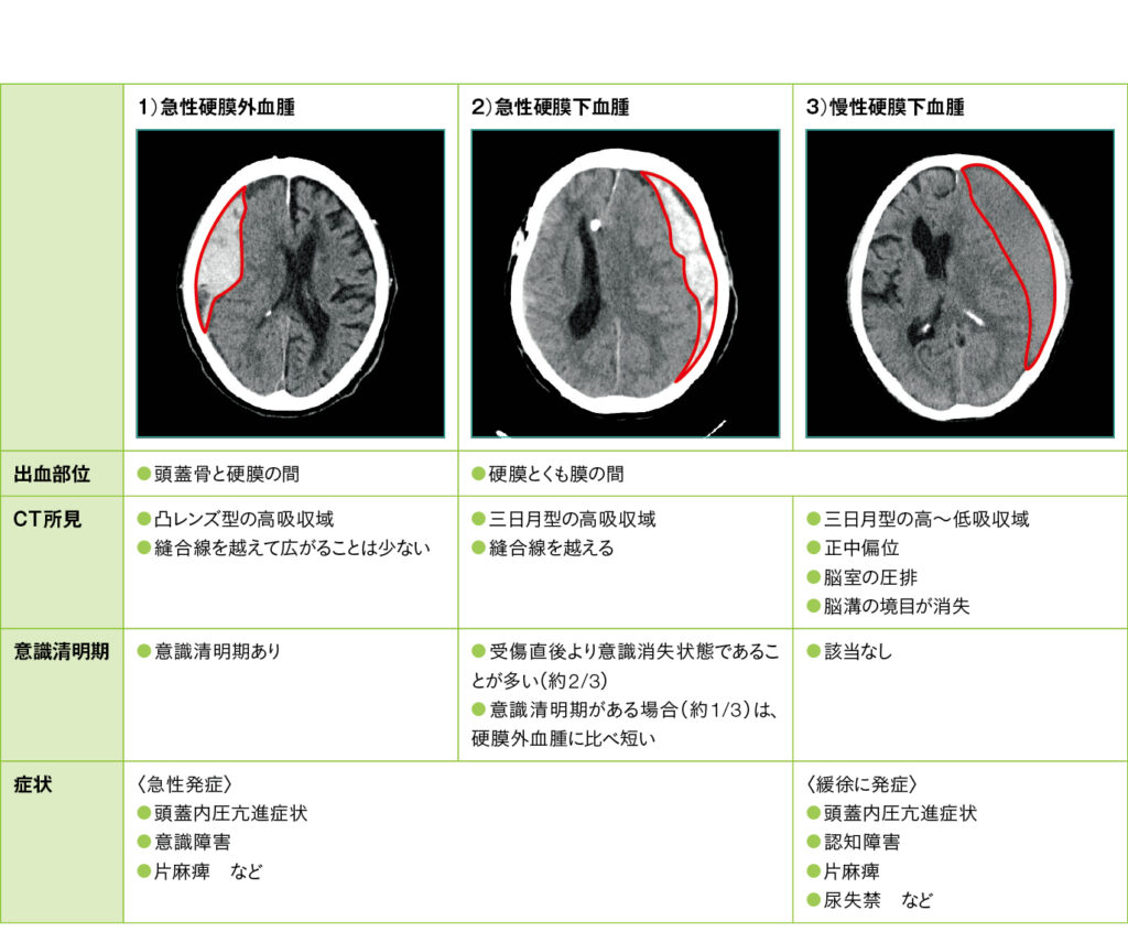 急性硬膜外血腫、急性硬膜下血腫、慢性硬膜下血腫の鑑別のポイントの表