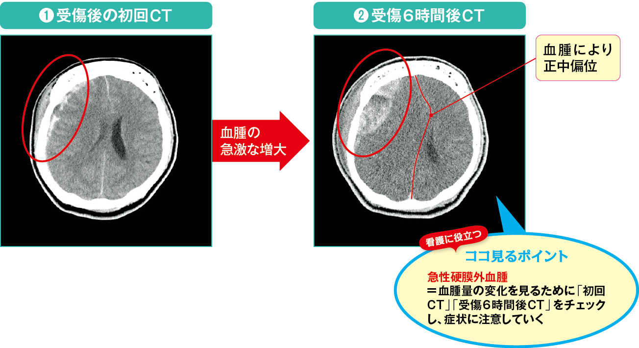 血腫の増大の観察の画像