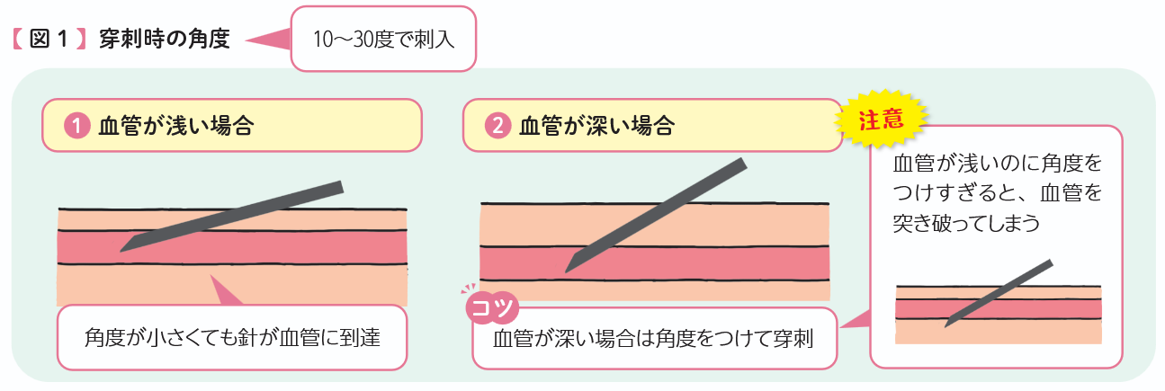 穿刺時の角度の図