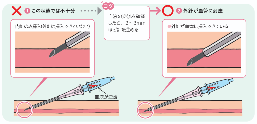 留置針刺入の際の注意点の図