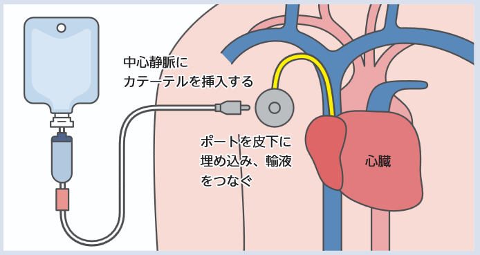 CVポートのしくみの図