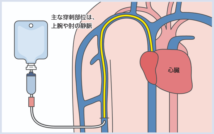 PICCのしくみの図
