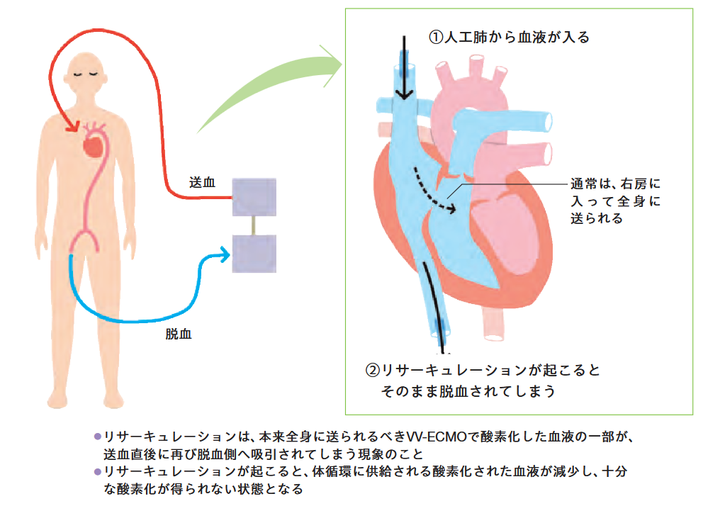 リサーキュレーションの起こるメカニズムの解説図