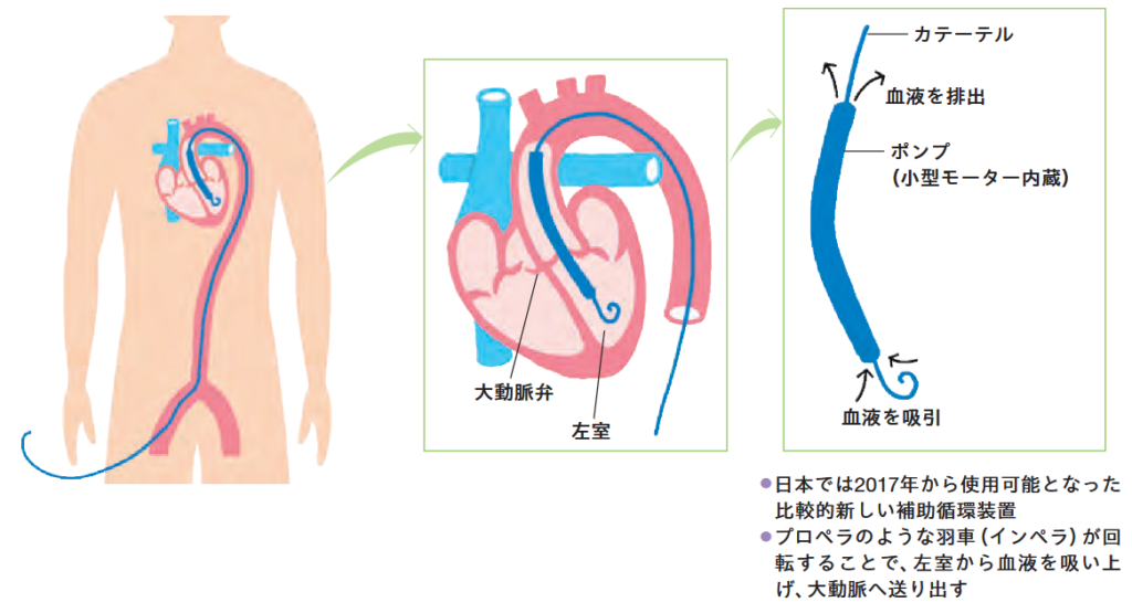 IMPELLA（補助循環用心内留置型ポンプカテーテル）のしくみ