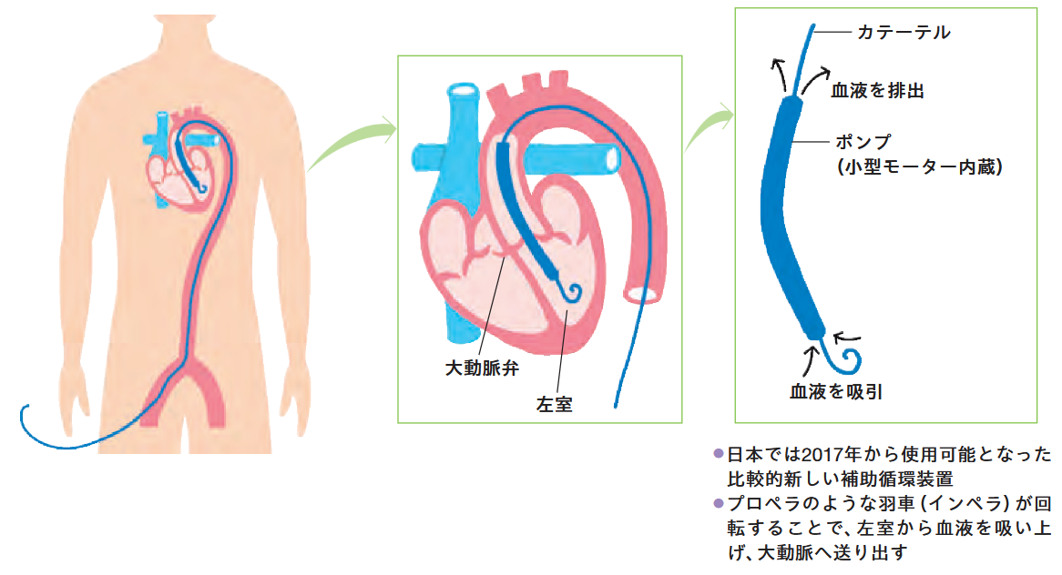 IMPELLA（補助循環用心内留置型ポンプカテーテル）のしくみ